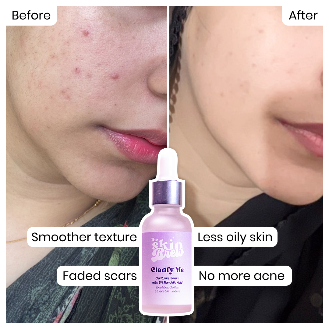 Before and after acne comparison of skin with clarify me serum